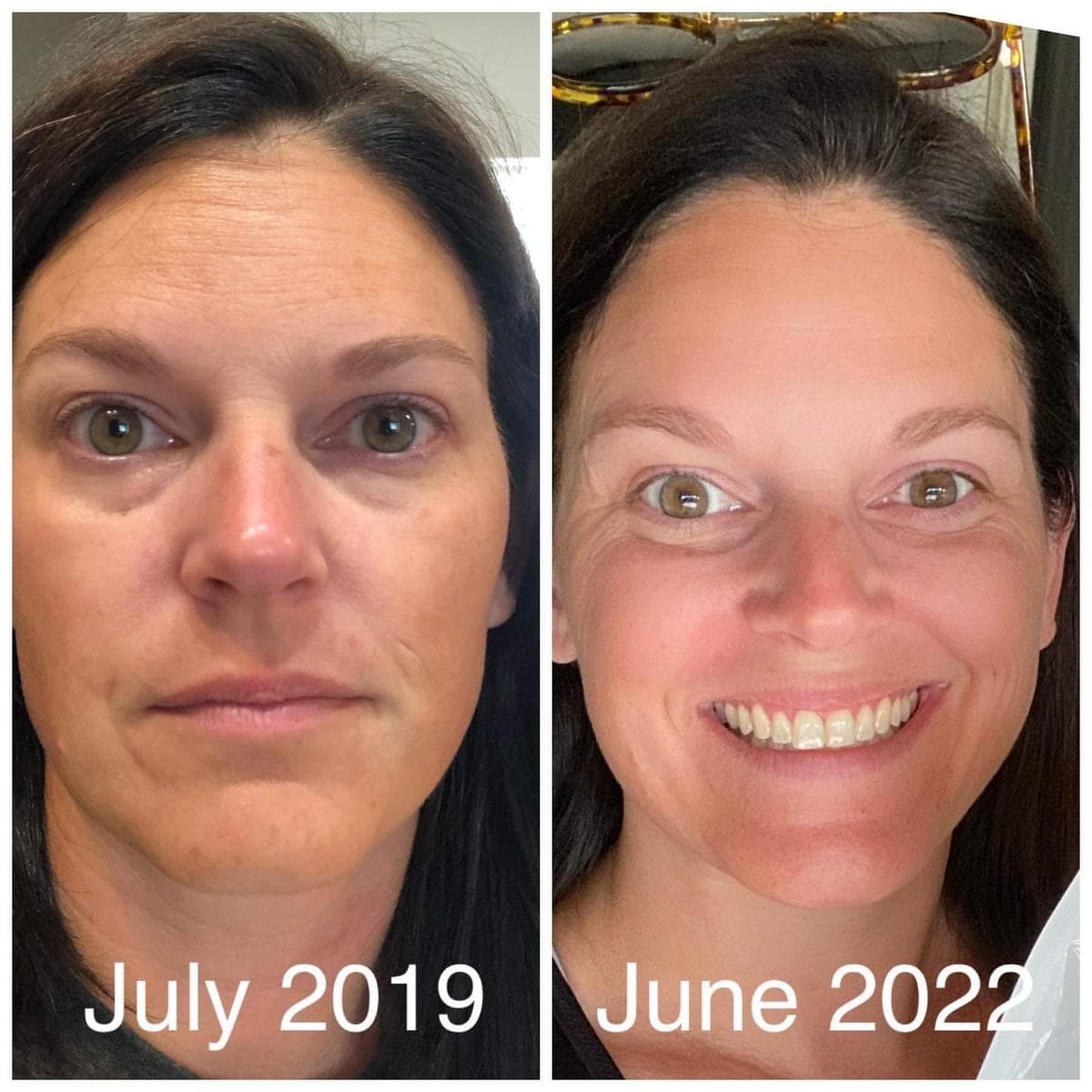 Close-up of the ageLOC LumiSpa iO device treatment head