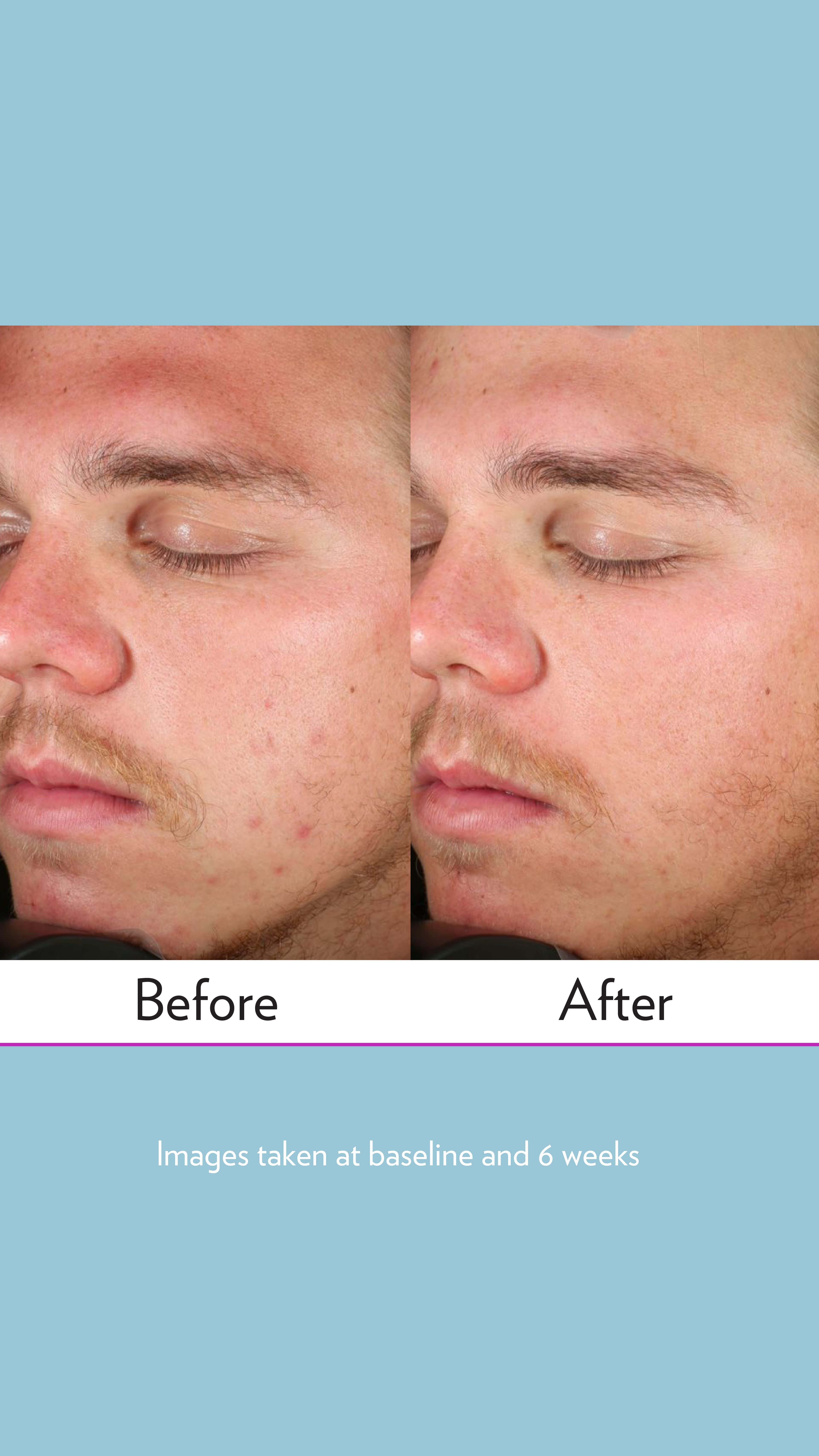 LumiSpa Acne System before and after study result
