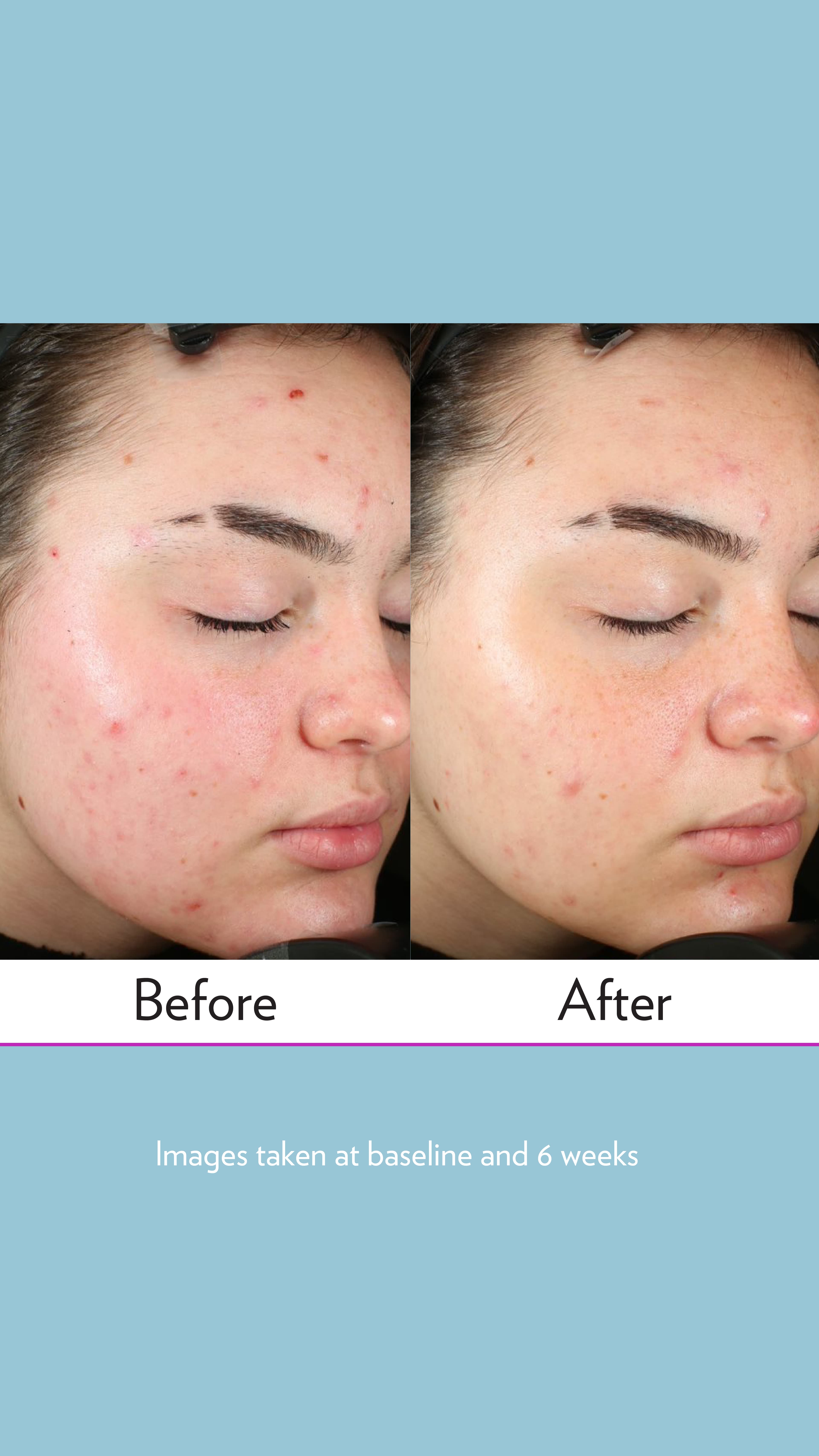 LumiSpa Acne System before and after study result