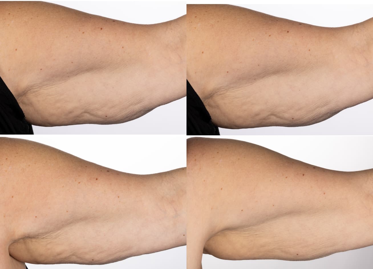 WellSpa iO before and after clinical study result