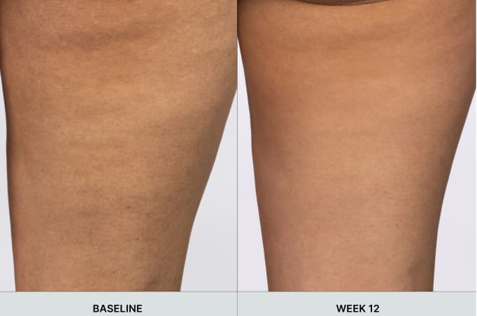 RenuSpa iO before and after clinical study result